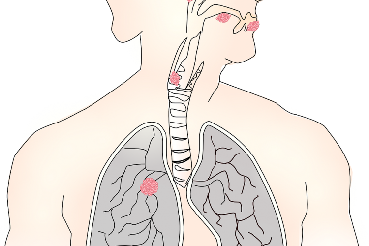 diagnóstico de mesotelioma